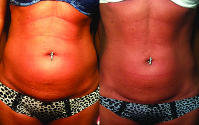 Venus Legacy - Before and After 8 Treatments.  Photos provided courtesy of Venus Concept.
