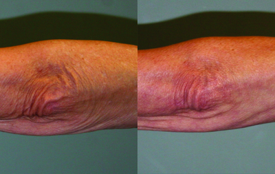 Venus Legacy - Before and After 4 Treatments.  Photos provided courtesy of Venus Concept, performed by Dima Ali, MD.