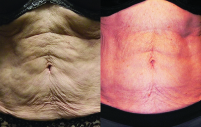 Venus Legacy - Before and After 10 Treatments.  Photos provided courtesy of Venus Concept.