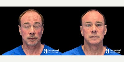 55-64 year old man treated with Dysport - The patient is a 59-year-old male with concerns about facial fine lines and wrinkles. Dr. Chiang used wrinkle relaxer (Dysport) to treat the forehead, glabella, crow's feet, under-eyes, and upper lip to address these concerns. The after results are 6 weeks post-treatment.