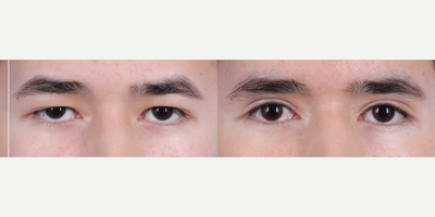 Man treated with Eyelid Surgery - Man treated with Eyelid Surgery