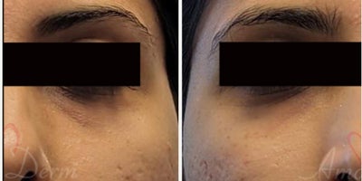 35-44 year old woman treated with Juvederm, Volbella, Voluma - 4D Under Eye Lift - Treatment of dark circles & bags under eyes and cheek restoration with Belotero, Restylane, Volbella and Voluma