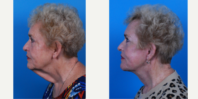 65-74 year old woman treated with Facelift, Eyelid Surgery, Laser Resurfacing - Dr. Becker performed a Facelift, Contour Full Face TRL Laser Resurfacing, Blepharoplasty Transconjunctival with Fat Repositioning, and Bilateral Upper Blepharoplasty.
