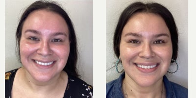 35-44 year old woman treated with Skin Rejuvenation, SkinPen, Microneedling, VI Peel - This patient came in seeking improvement of skin texture and tone. Using a Citrus Signature Skin Refresh of interchanging medical grade VI Peels with SkinPen microneedling treatments, we did six consecutive treatments interchanging them, every four weeks apart. This achieved improvement of skin texture, redness of the skin, overall skin tone and gave a beautiful skin glow. We focused on enhancing her skin through collagen production and addressing pigmentation and texture. She looks so refreshed and rejuvenated after the Citrus Signature Skin Refresh. Every treatment at Citrus Aesthetics is guided by ethics, safety, anatomical knowledge, intention of meeting clients unique goals, and a commitment to natural outcomes.