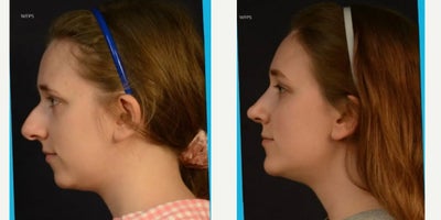 18-24 year old woman treated with Rhinoplasty, Chin Implant - 18-24 year old woman treated with Rhinoplasty, Chin Implant