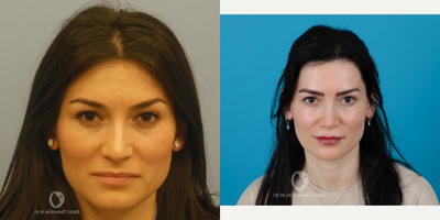 35-44 year old woman treated with Rhinoplasty - 10 years later