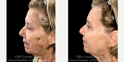 75 and up year old woman treated with Skin Lightening, Skin Rejuvenation, IPL - 75+ year old patient treated with a series of 3 Elluminate with IPL Photofacial treatments for skin concerns of age spots, sun damage and hyperpigmentation of the face. The result was an overall brightening of her skin and complexion and significantly improved age spots and sun spots giving her skin a more youthful appearance. These results were achieved with a series of (3) treatments, 4-6 weeks apart.