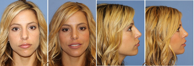 Revision Rhinoplasty - Nose Patient - This patient had undergone open rhinoplasty surgery in the past. Still unhappy, and having new breathing issues, she sought out Dr. Sadati. 2 months after revision rhinoplasty surgery the patient breaths better.