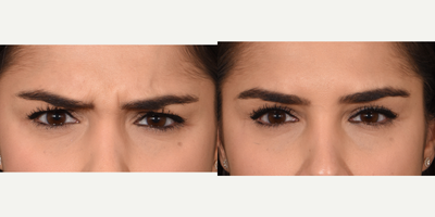 25-34 year old woman treated with Botox - 25 year old female treated with botox to 11's to prevent vertical lines from forming. She is making an angry face in both before and after photos.