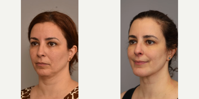 Woman treated with Chin Implant - Woman treated with Neck Lift and Chin Implant. Patient came in wanting a nicely defined jawline and to clean up her neck to achieve a more youthful look.