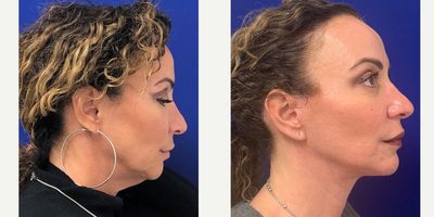 45-54 year old woman treated with Facelift - My 49 year old patient 3 months post a Facelift, Neck lift, Fat Transfer, Upper Blepharoplasty and CO2 laser. You can see her jawline, lower face and neck are nicely defined and contoured, she has more volume in the mid face from the fat transfer, the jowling is no longer and the shape of her mouth has remained the same, she has more eyelid space and her skin tone is more even and smoother.