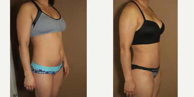 25-34 year old woman treated with Liposuction - liposuction and abdominoplasty