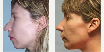 35-44 year old woman treated with Chin Implant - This lady initially dislikes her nasal profile but her small chin seems to visually exaggerate the nasal projection (an illusion). In-office chin augmentation performed under local anesthesia shows a more harmonious profile enhancement in meridian.