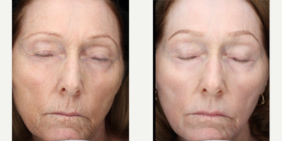 55-64 year old woman treated with Scar Removal, Laser Scar Removal - Full face laser resurfacing