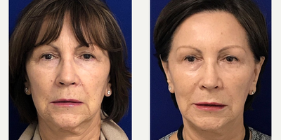65-74 year old woman treated with Restylane - Liquid Facelift on my 70 years young patient. I used Restylane classic to plump her lips, Restylane Defyne in the nasolabial folds & marionette lines to soften & reduce the deep creases, Restylane Lyft in her cheeks to restore facial volume & to also lift the lower part of the face (jawline) and last but not least Dysport to address fine lines. 2 weeks post treatment, she is extremely happy with her rejuvenated appearance!