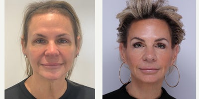 55-64 year old woman treated with Facelift, Neck Lift, Facial Fat Transfer, CO2 Laser - Patient is now 60 years old and is 4 years after facelift, neck lift, fat transfer and co2 laser with Dr. Madnani.