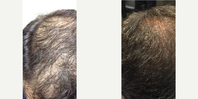 Man treated with Hair Loss Treatment - Man treated with Hair Loss Treatment