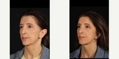 55-64 year old woman treated with Facelift, Neck Lift, Eyelid Surgery, Double Eyelid Surgery, Facial Fat Transfer - We're 3 months out from a deep plane face and neck lift, upper blepharoplasty, lower blepharoplasty, and facial fat grafting and our patient is healing beautifully! Her surgery to me highlights how helpful facial fat grafting can be. She is in beyond excellent shape and carries almost no extra weight, which is true in the face as well. A little fat grafting along with the lift helps rejuvenate the face and neck. Thanks to her for letting us share!
