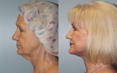 Woman treated with Facelift - Woman treated with Facelift