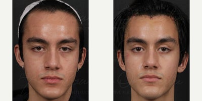 18-24 year old man treated with Forehead Reduction - A young male patient underwent forehead reduction. The images show her natural-looking results at 10 days postoperatively, with improved facial balance and rejuvenation.