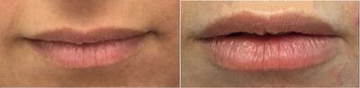 Woman treated with Juvederm - Woman treated with Juvederm.