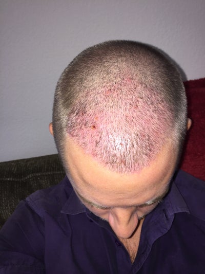 Will Folliculitis 8 Days Post Hair Transplant Effect Graft Growth 