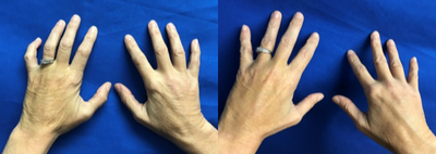 45-54 year old woman treated with Hand Rejuvenation (Fillers) - This patient's hands had lost collagen, showing crepey skin and veins. After treatment of dermal fillers, hands show more volume and a younger appearance.