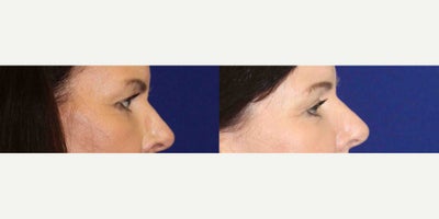 45-54 year old woman treated with Eyelid Surgery - 47 year old patient complaining of her tired looking and heavy upper eyelids. Here she is 3 months after her Upper Eyelid Blepharoplasty.