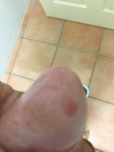 Scar On My Penis 107