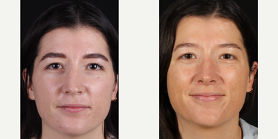25-34 year old woman treated with Revision Rhinoplasty - Rhinoplasty B&A - performed with rib cartilage grafting.