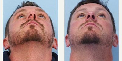 35-44 year old man treated with Rhinoplasty - He suffers from right greater than left nasal obstruction due to multiple nasal trauma. He finally decides to undergo corrective surgery for crooked nose and postoperatively he quotes: I am 100% better.