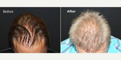 Man treated with Hair Loss Treatment - Man treated with Hair Loss Treatment through Hair Transplant