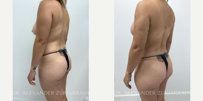 25-34 year old woman treated with Mommy Makeover, Breast Augmentation, Breast Lift - 25-34 year old woman treated with Mommy Makeover, Breast Augmentation, Breast Lift- 3 months post-op