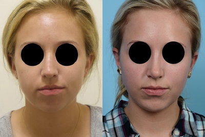 Woman treated with Chin Implant - Woman treated with Chin Implant