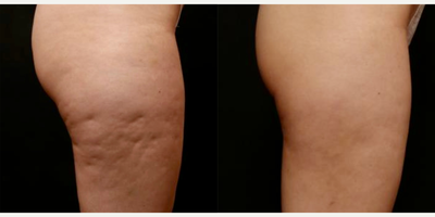25-34 year old woman treated with Aveli - 29y/o with lateral thigh dimples that prevented her from feeling comfortable in a bathing suit since she was 13! One treatment with Aveli reduced the cellulite dimples to the point where she is happy to show her legs in swim wear