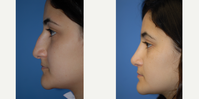 18-24 year old woman treated with Rhinoplasty - Very droopy nose reshaped with rhinoplasty