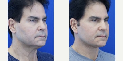 55-64 year old man treated with Deep Plane Facelift, Eyelid Surgery, Neck Lift - Male hair and sideburn pattern affects incision pattern. Male facelift rejuvenates the aging face to give a slimmer, tighter, younger facial appearance. Postoperative comments include: What did you do? You look younger!