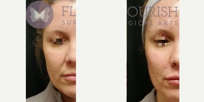 Woman treated with Volbella, Vollure, Botox, Voluma - I love getting selfies from happy patients! This beautiful patient wanted increased volume in her lips and disliked her nasolabial folds. She already had nice lip architecture so I used 1 syringe of volbella for a soft, natural plump to the lips. 1 syringe of Voluma to lift and augment the cheek bones, and 1 syringe of Vollure to soften her nasolabial folds. We also treated her glabella, forehead, and crow's feet with Botox. I find it's best to treat the entire face to get a natural and subtle result. She looks rested, rejuvenated, and ready for the Holidays! 1st photo : Before & Immediately After2nd Photo : 10 days post treatment