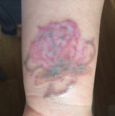 Tattoo Laser Removal - Wrist - PicoSure review - RealSelf