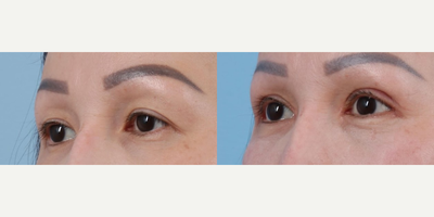 Woman treated with Eyelid Surgery - Upper Blepharoplasty