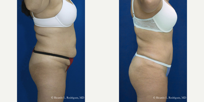 Tummy Tuck - Tummy Tuck