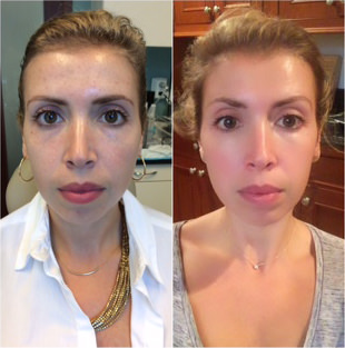 Clear & Brilliant - Woman treated with Clear & Brilliant