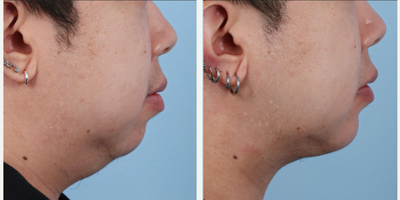 Man treated with Chin Liposuction, Renuvion, Chin Augmentation - Submental Liposuction Plus Renuvion Skin Tightening and Chin Augmentation One month Post Op