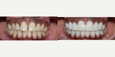 25-34 year old woman treated with Porcelain Veneers - Great result, white color selection, good shape and happy patient.