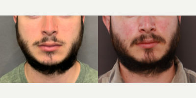 25-34 year old man treated with Beard Transplant - Facial Hair transplant 300 grafts to mustache, chin strap, and patchy areas of beard