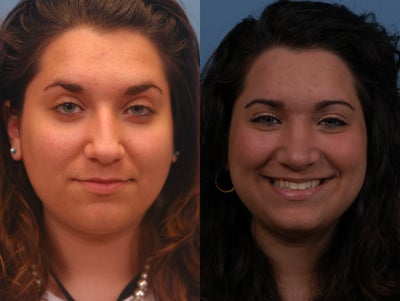 Rhinoplasty Before and After - Removing a large hump can drastically change the appearance of the face and the demeanor of a patient.