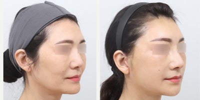 45-54 year old woman treated with AccuLift, Mini Facelift - This before-and-after photo showcases the results of a comprehensive facial contouring and rejuvenation procedure. Accu jawline and double chin contouring refined the lower face, while forehead and front cheek enhancement restored youthful volume. Nasolabial fold correction softened smile lines for a smoother appearance.A Mini Face Lift with Endotine fixation, along with lateral and lower lifting techniques, improved facial sagging and definition. Eye revision surgery further enhanced symmetry, resulting in a naturally lifted, balanced, and refreshed look.