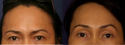 Forehead Reduction - FFS- Hairline Forehead Lift (Brow Lift) - Hairline Lowering (Forehead Reduction) - Orbital Bony Contour (Brow Bone Reduction)