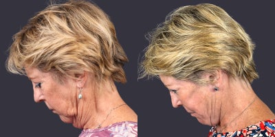 65-74 year old woman treated with Facelift, Eyelid Surgery, CO2 Laser, Skin Rejuvenation, Lower Facelift, Neck Lift, SMAS Faceli - This 68 year old woman is 5'2 and 129 pounds. She presented requesting facial rejuvenation. She had a deep plane - SMAS facelift and neck lift, lower eyelid blepharoplasty, corner of the mouth lift, and central face skin rejuvenation with CO2 laser resurfacing.