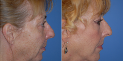 55-64 year old woman treated with Facelift - Nice improvement in jawline and neck with lower face and necklift